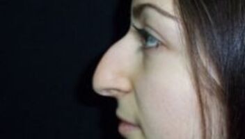Женщина, которая хочет изменить форму носа (ринопластика) 