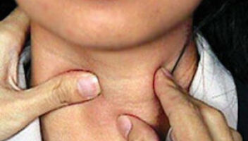 Ищем людей у которых есть проблемы со щитовидной железой 