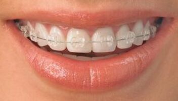 Герои 25-45 лет, у которых неровные зубы