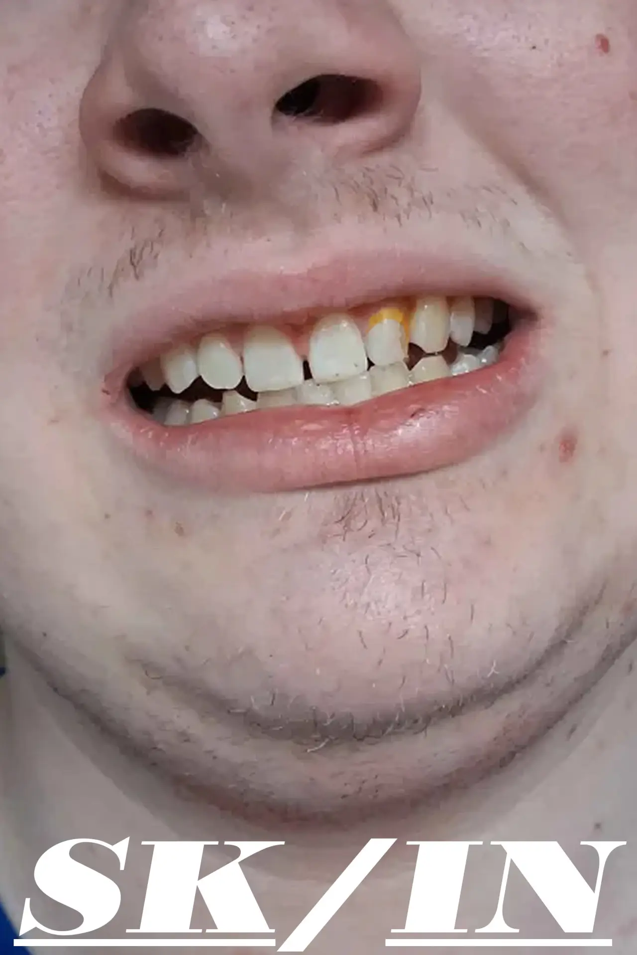 Постер до фільму "Skin"