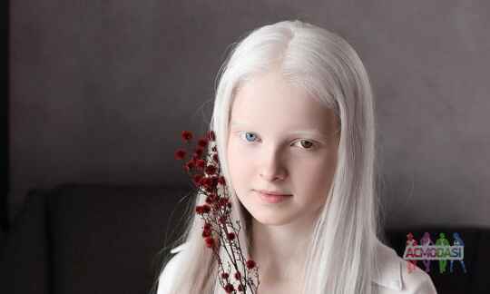 Девушка-альбинос/с витилиго для стоковой съемки