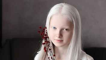 Девушка-альбинос/с витилиго для стоковой съемки