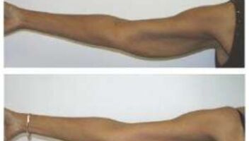 Нужны девушки у которых возникла проблема с дряблой кожей рук, так называемые крылышки, тогда вам точно ко мне!